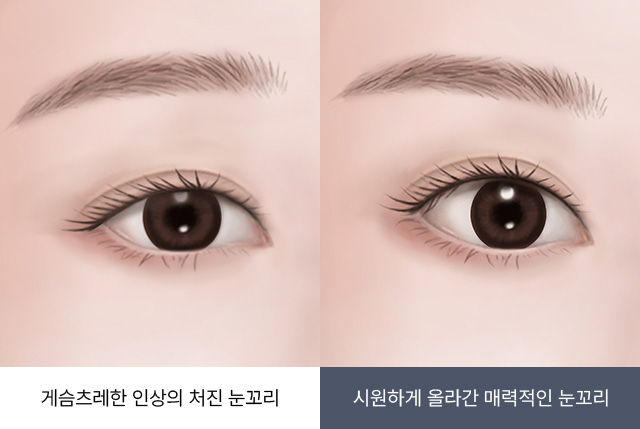 유앤미의원,유앤미클리닉,유앤미,강남유앤미,신논현유앤미,논현유앤미,서울유앤미클리닉,서울피부과,서울클리닉,한국피부과,눈꼬리리프팅,눈매교정잘하는곳,강남눈매교정,강남쌍커플수술,쌍커플수술잘하는곳,안검하수교정,눈밑지방재배치,눈매교정가격,강남얼굴리프팅,강남실리프팅잘하는곳,실리프팅,안검하수교정병원,눈가주름시술